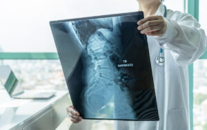 How Can Jay Murray Personal Injury Lawyers Help After a Spinal Cord Injury?
