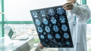 How Jay Murray Personal Injury Lawyers Can Help After a Brain Injury in Dallas