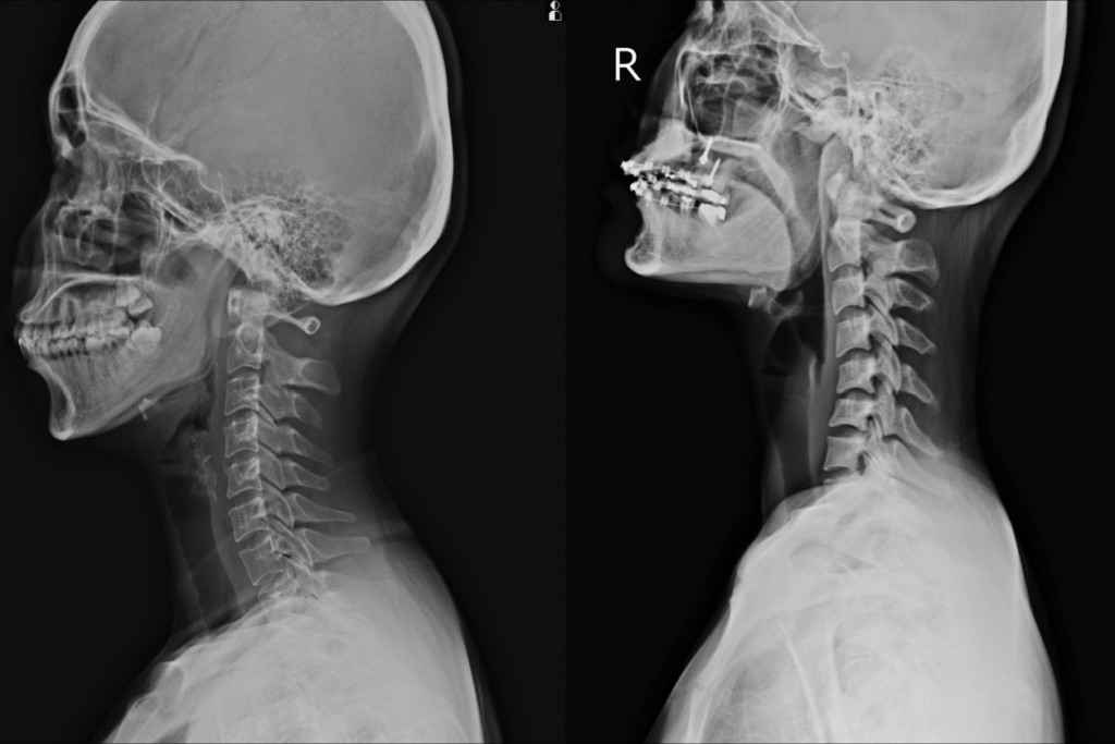 Many Accidents Can Cause Herniated Discs At C4/C5 Or C5/C6: Here’s What You Need To Know